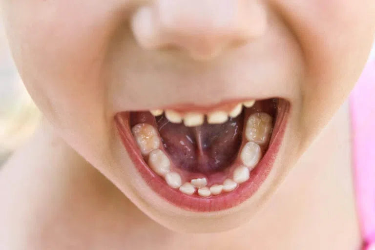Orofacial Myofunctional Therapy